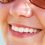 Teeth Whitening: Optimizing Your Smile