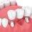 How Dental Bridges and Implants Can Help Your Smile