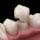 6 Common Dental Crown Problems & How To Avoid Them